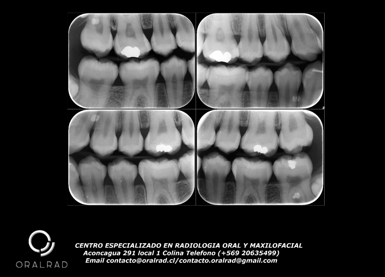 Treatment of Dental Caries. New Practice(Tratamiento de la caries dental. Nueva práctica)